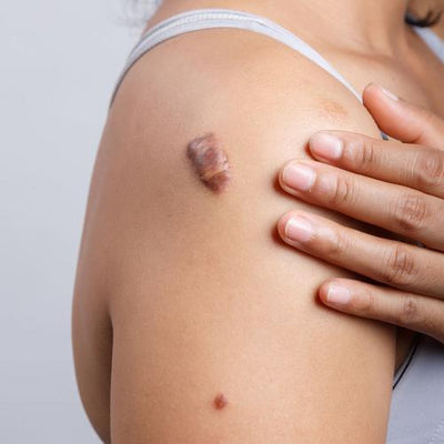 Itching scars? Stop eating tomatoes! (and some other vegetables)