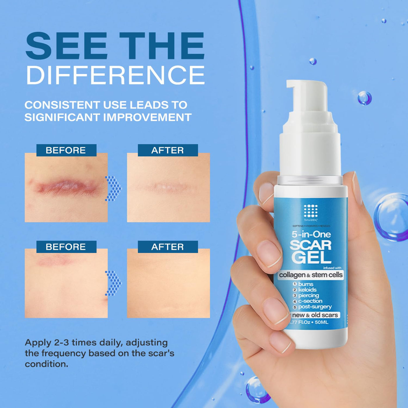 5-in-1 Scar Cream for Surgical Scars